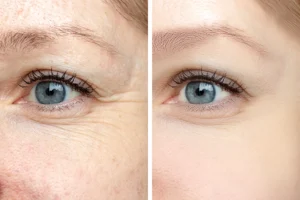 Side-by-side picture of a woman in Farmer’s Branch, TX. Before picture with wrinkles and after picture with less wrinkles after using Jeuveau®.