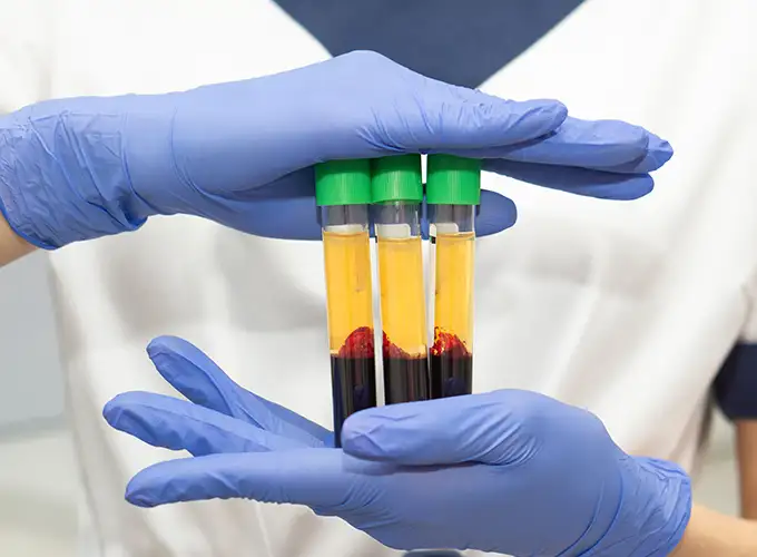 Platelet-Rich Plasma Therapy for Natural Healing
