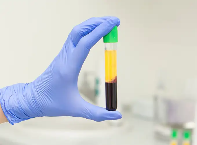 PRP Therapy in Dallas TX